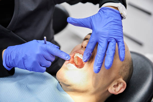 Teeth Whitening in LA