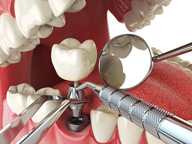 Best Chipped Tooth Repair Near Me  in Bayou Lourse, LA